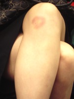 I was drunk on the tube and saw the bruise on a woman's leg, so I zoomed in on it. I am not a pervert. Or am I?