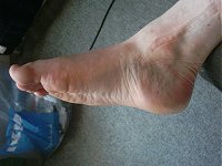 My foot, with an imprint left by a sock